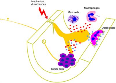 Molecular Mechanisms That Contribute to Bone Marrow Pain